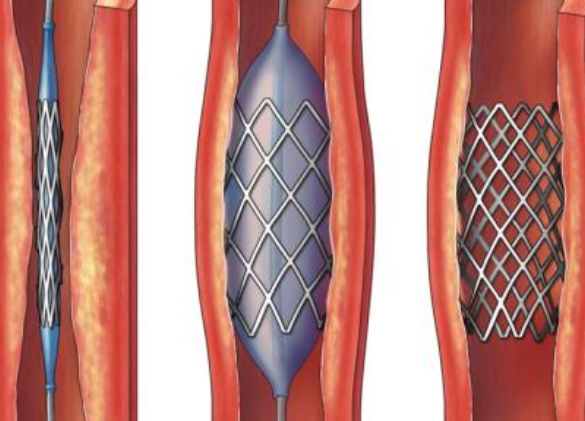 好消息！700元冠脈支架來了帶量采購結(jié)果在甘肅省正式落地執(zhí)行